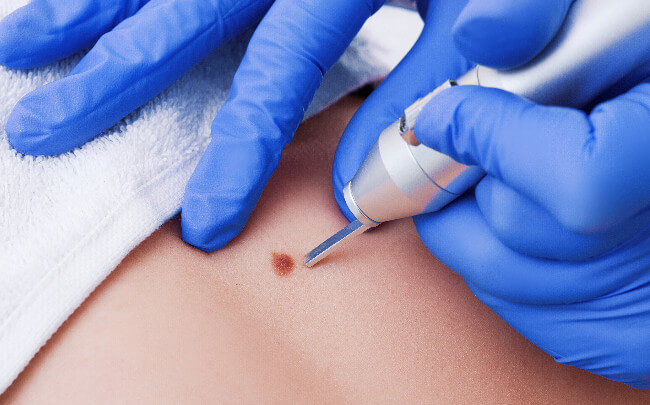 Laser chirurgia dermatologica