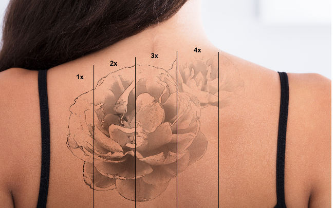 Trattamenti con Laser Q-switched