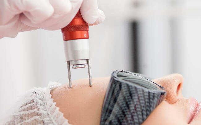 Trattamenti con Laser CO₂