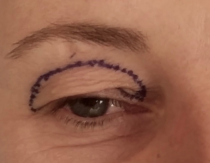 Blefaroplastica non chirurgica