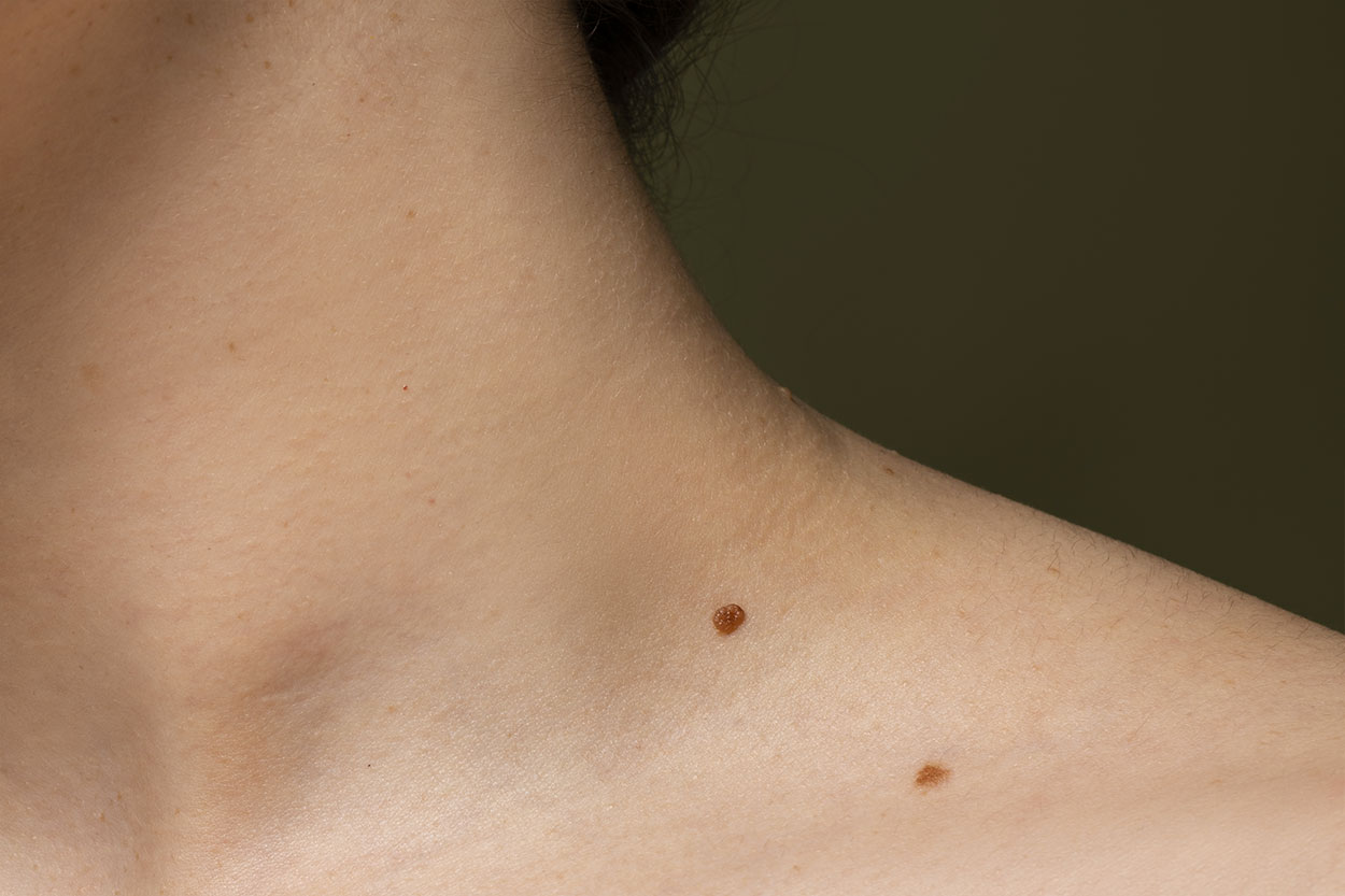 Mappatura dei Nei: Quando Farla e Perché è Importante